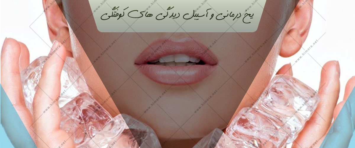 یخ درمانی